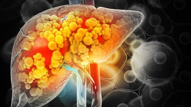 Liver Fibrosis