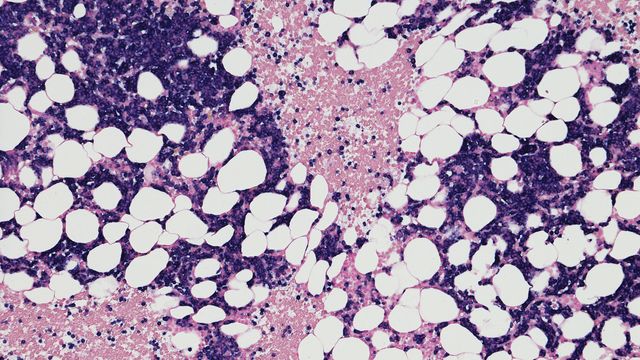 Cancerous tissue