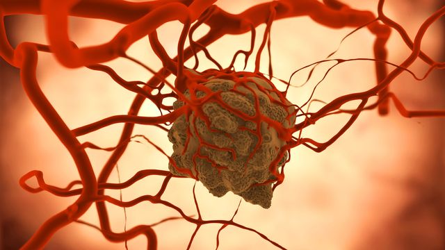 Tumor with blood vessels.