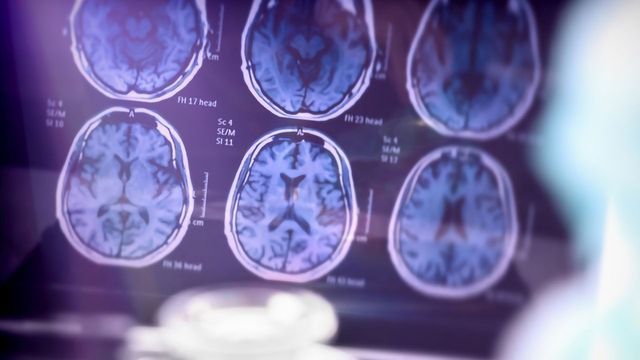 Three Advances in Alzheimer’s Disease Diagnostics content piece image